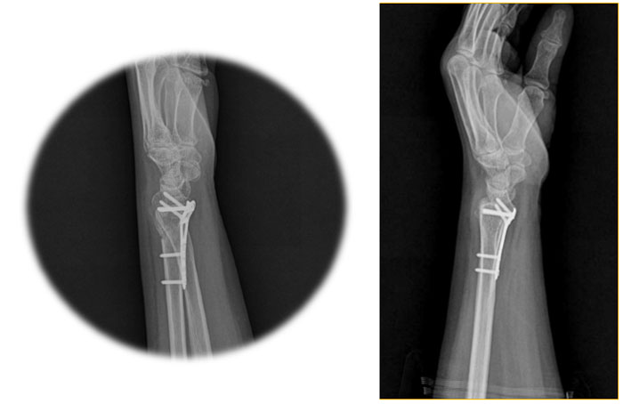 Distal Radius Plates